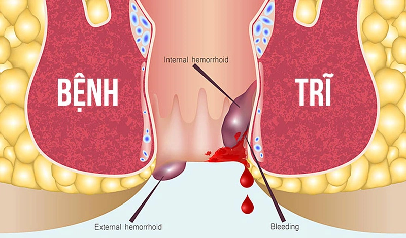 Tìm hiểu về các loại thuốc trị bệnh trĩ và những lưu ý khi sử dụng 1