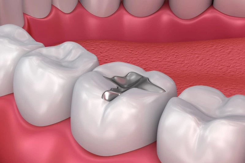 Có thể trị sâu răng nhẹ bằng cách hàn trám