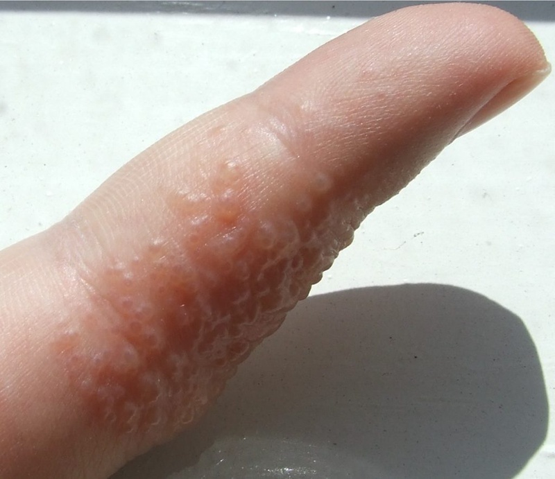 Tổ đỉa dị ứng: Nguyên nhân và xử trí 1