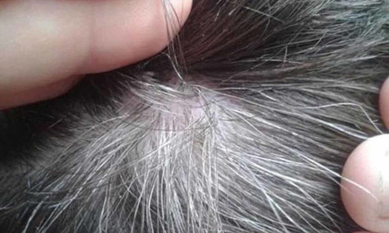Tác hại của nhổ tóc bạc là gì?