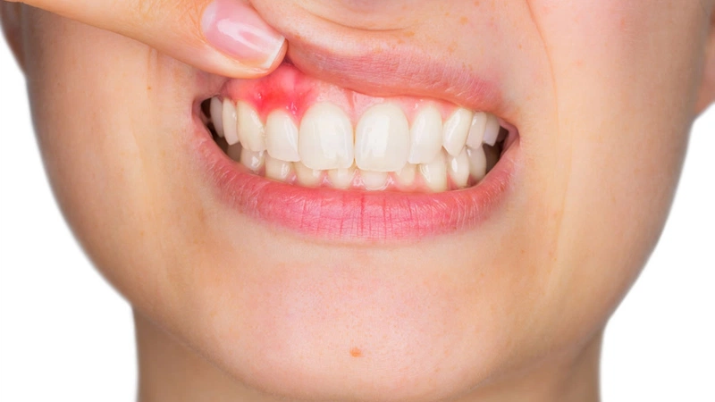 Tổng quan về bệnh răng miệng: Bị viêm lợi có nên lấy cao răng không 1