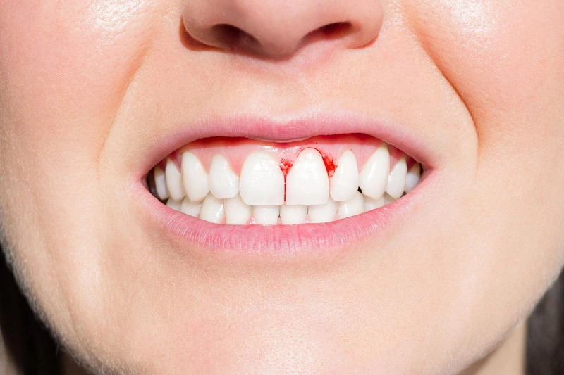 Tổng quan về bệnh răng miệng: Bị viêm lợi có nên lấy cao răng không 3