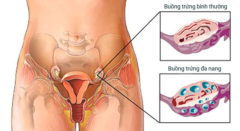Trễ kinh ra máu đen liệu có nguy hiểm không? 2
