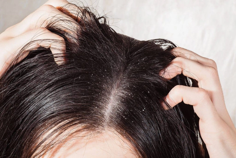 Trị gàu, chăm sóc tóc chắc khỏe với tinh dầu tràm 2