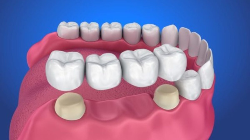 Trồng răng hàm giá bao nhiêu? Những điều cần lưu ý khi trồng răng hàm 3