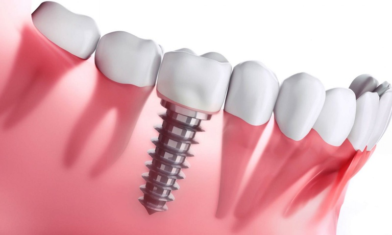 Trồng răng hàm giá bao nhiêu? Những điều cần lưu ý khi trồng răng hàm 4