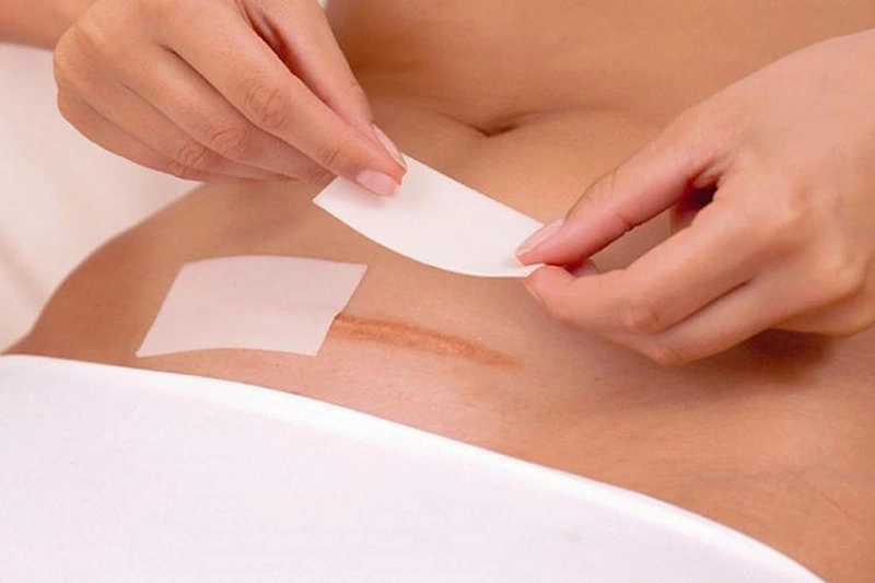 Tùy vào loại vết mổ mà thời gian được tắm sau khi phẫu thuật sẽ khác nhau 3