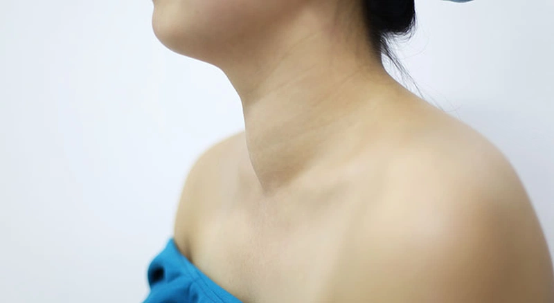 Bướu cổ có chết không 1