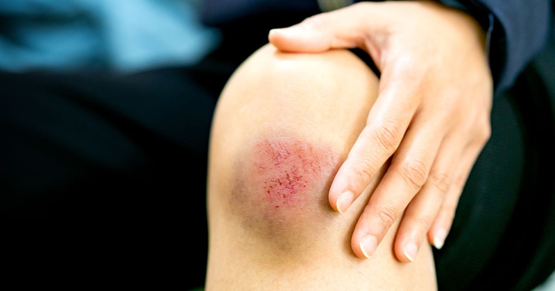 Chăm sóc vết thương hở đúng cách để tránh bị nhiễm trùng 4