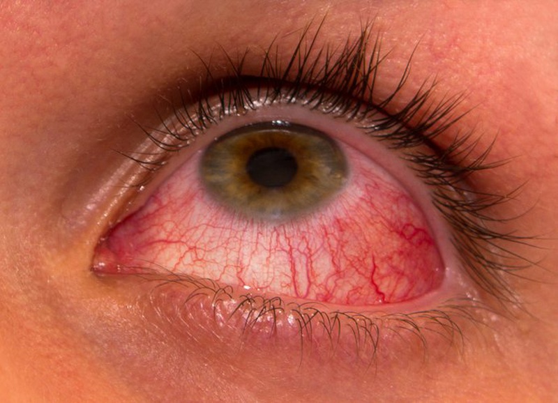 các triệu chứng đau mắt hột 1