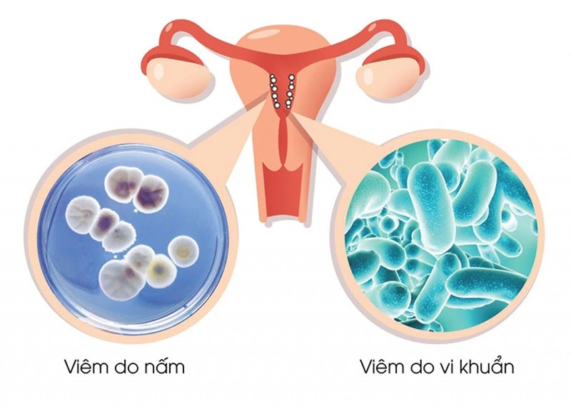 Viêm phụ khoa gây trễ kinh có sao không? 2