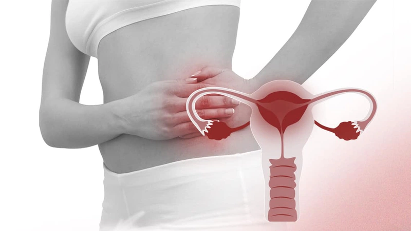 Viêm vùng chậu có thể khiến chu kỳ kinh nguyệt của bạn không đều 2