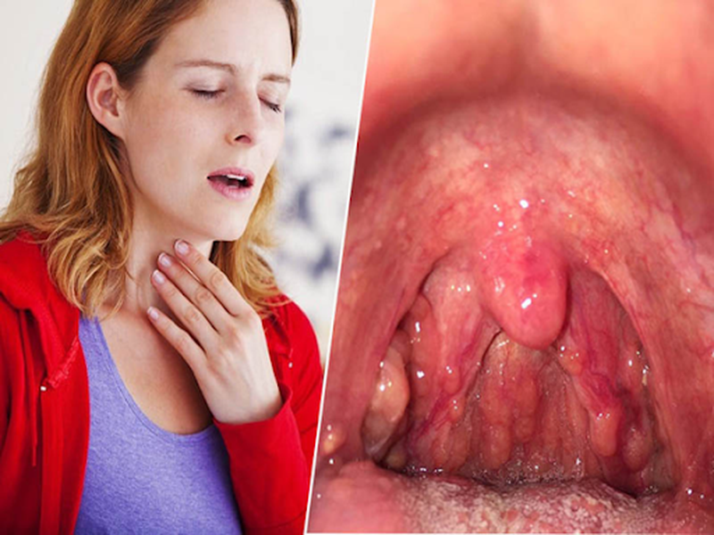 Nguyên nhân, triệu chứng và phương pháp điều trị viêm họng hiệu quả 1