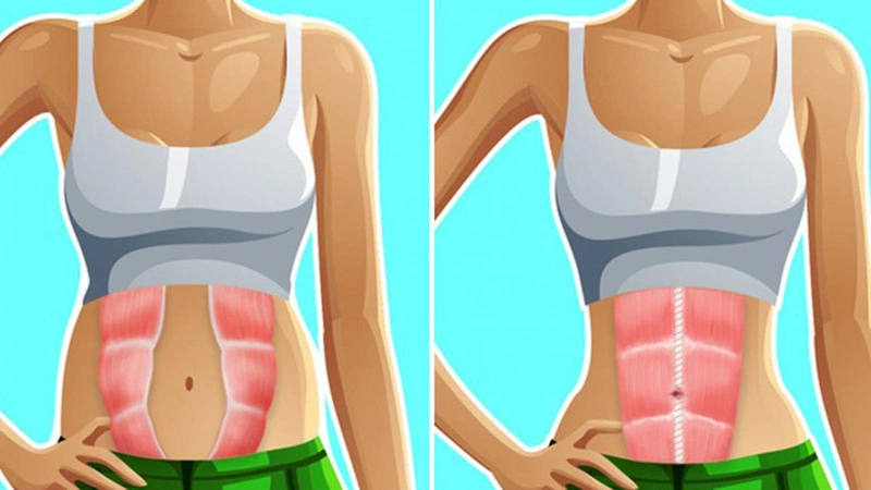 Sự khác biệt giữa người xổ bụng sau sinh và người không bị xổ bụng