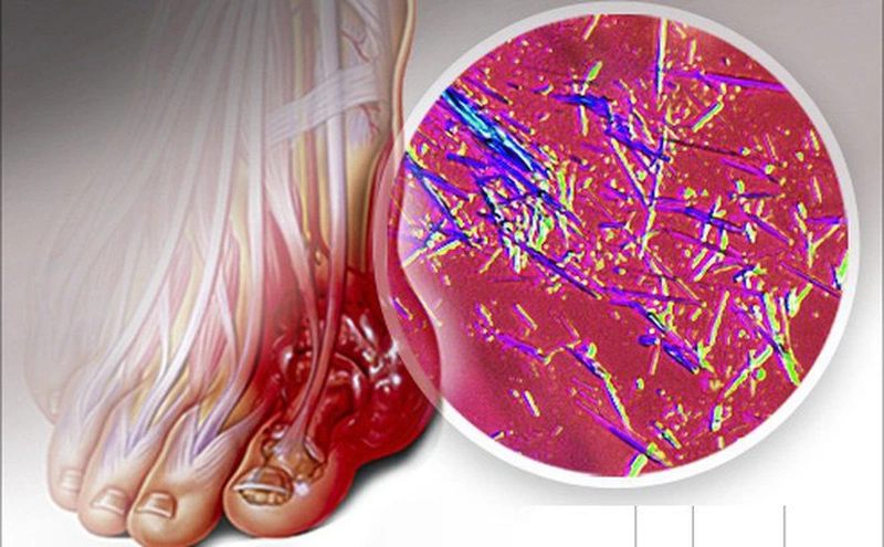 Acid uric là sản phẩm của quá trình chuyển hóa tự nhiên của cơ thể