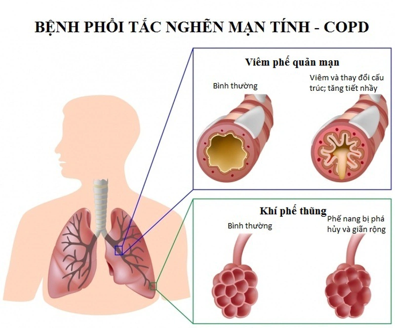 Các triệu chứng bệnh phổi tắc nghẽn mạn tính (COPD) thường gặp 1