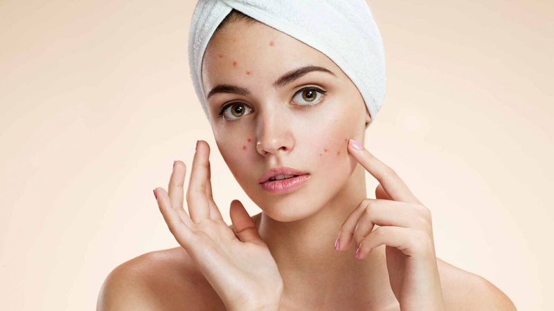 Ăn dưa lưới có nổi mụn không? Dưa lưới không gây mụn hỗ trợ làm đẹp da