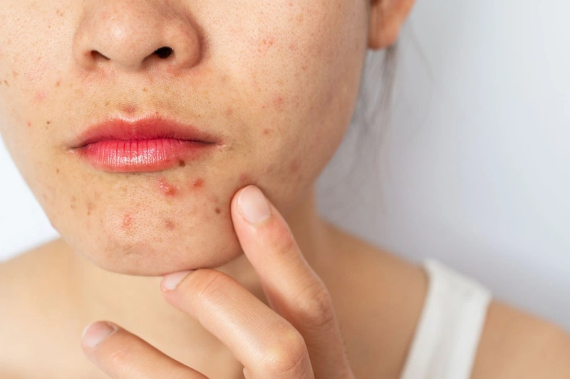 ăn mít có nổi mụn không 1