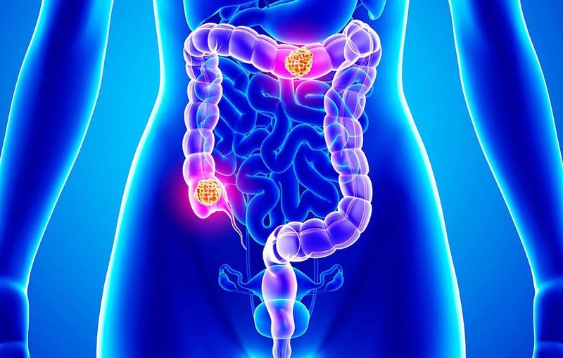 Ăn nhiều thịt xông khói có ảnh hưởng đến sức khỏe?