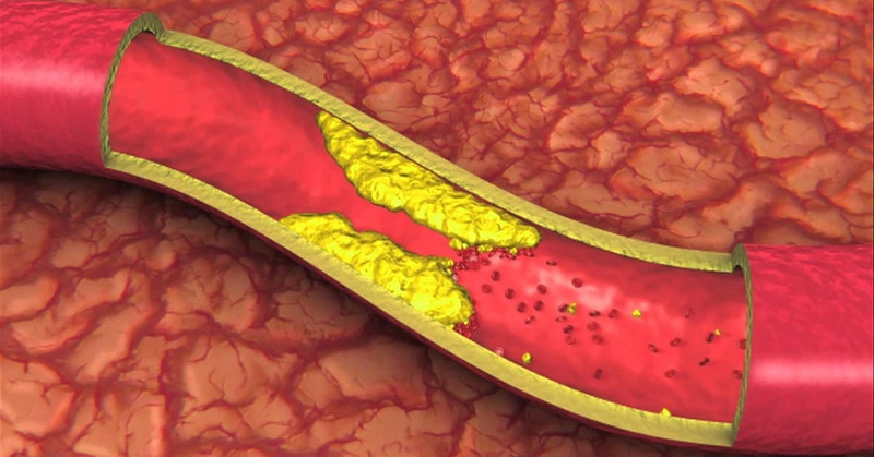 Nếu hàm lượng cholesterol trong máu cao (hay còn gọi là tăng mỡ máu) sẽ đẩy nhanh quá trình xơ vữa động mạch