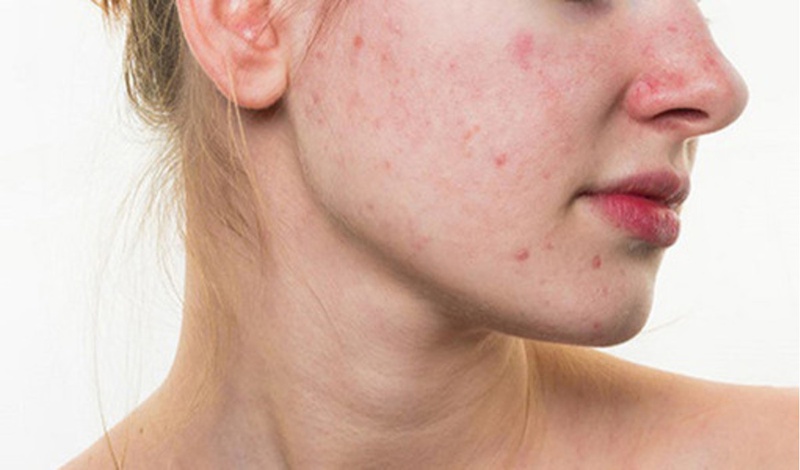 Giải đáp thắc mắc tại sao ăn thô bị nổi mụn 2