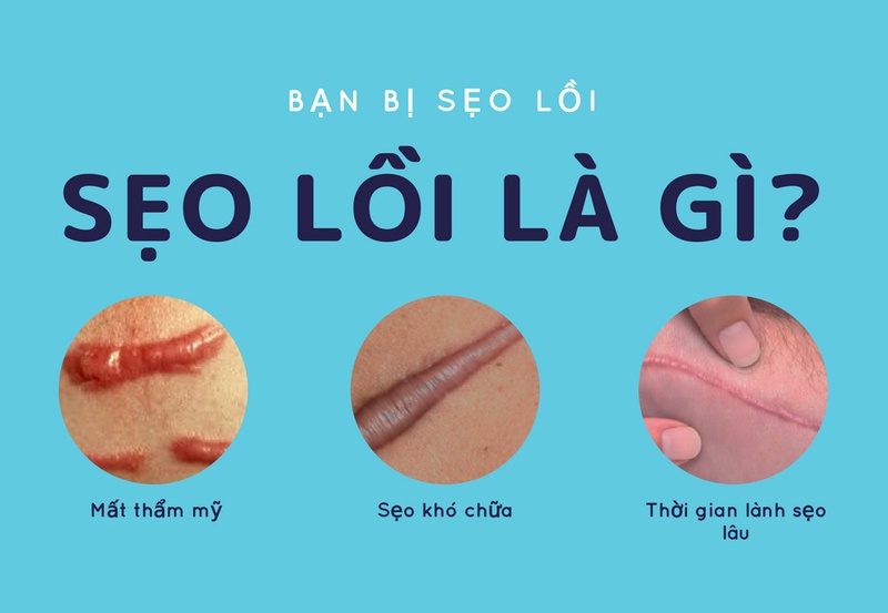 Ăn trứng có bị sẹo lồi không 1