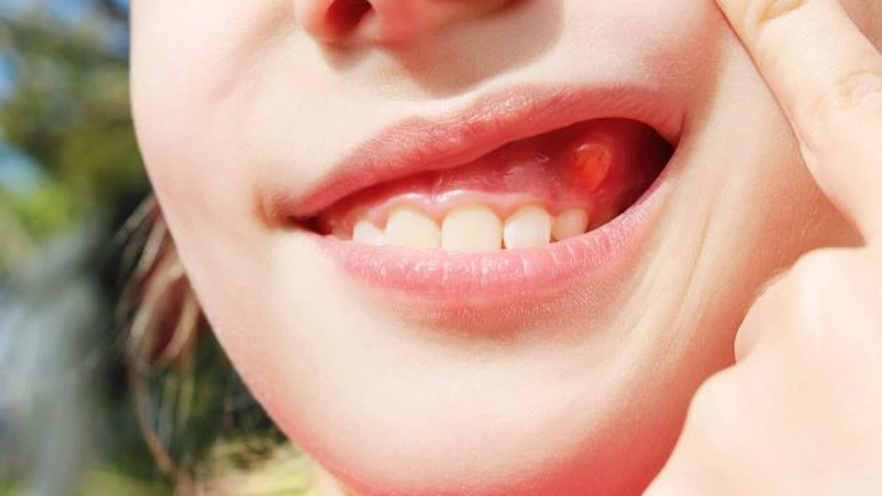 Áp xe răng có tự khỏi không? 1