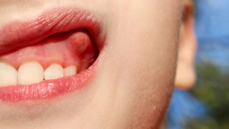 Áp xe răng - Nguyên nhân, triệu chứng, cách điều trị và phòng ngừa hiệu quả 1