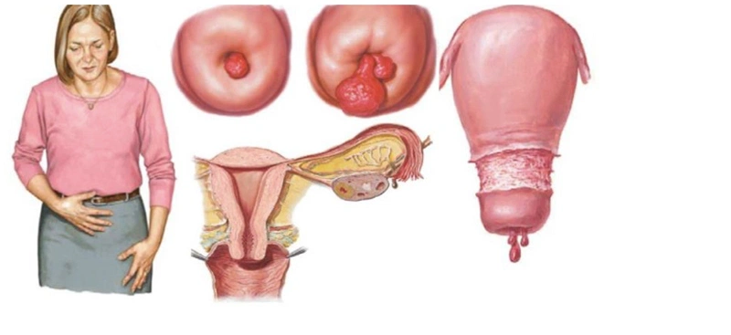 Dấu hiệu xuất hiện polyp cổ tử cung ở bà bầu