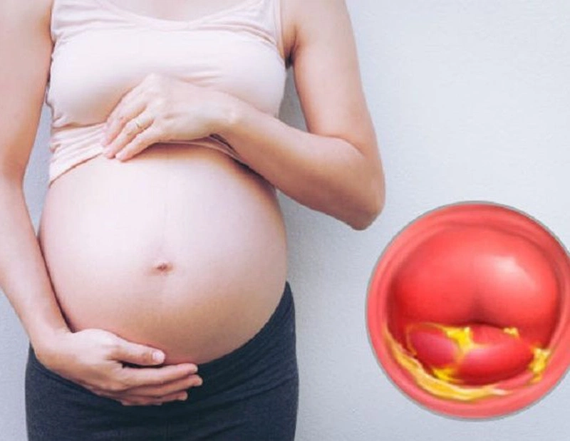 Nguyên nhân gây ra polyp cổ tử cung trong quá trình mang thai