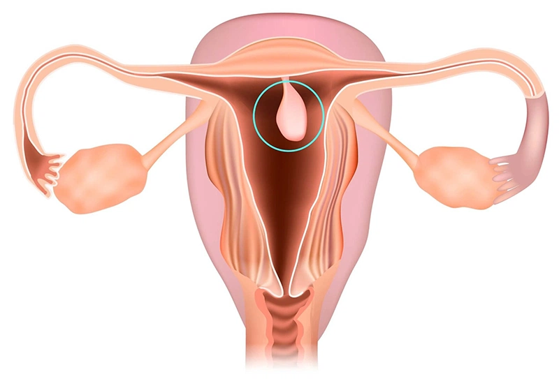 Polyp cổ tử cung được đánh giá lành tính