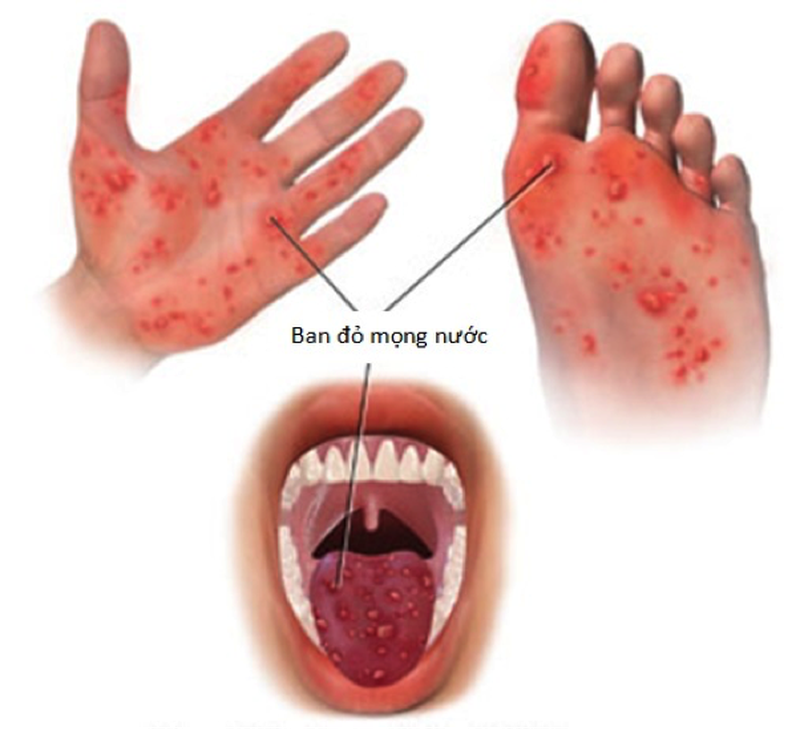 Bà bầu bị tay chân miệng có sao không-02
