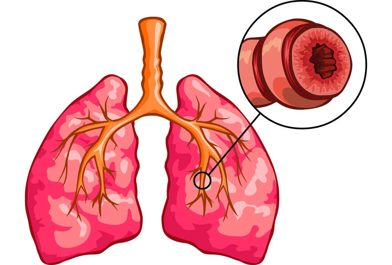 Điều trị viêm phế quản co thắt kịp thời tránh biến chứng nặng