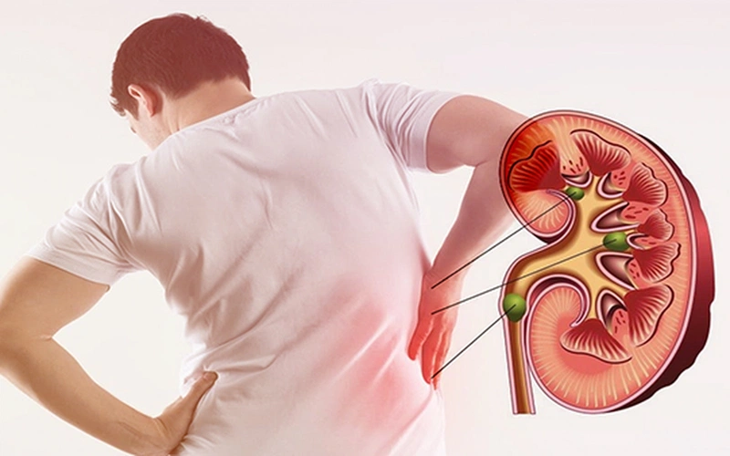 Kim tiền thảo làm giảm phù nề ở niệu quản, tạo điều kiện thuận lợi cho sỏi di chuyển xuống niệu quản và được đẩy ra ngoài