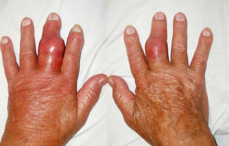 Bài thuốc trị bệnh gout hiệu quả từ thiên nhiên 1