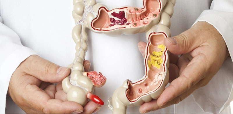 Bạn biết gì về phẫu thuật Altemeier? 1