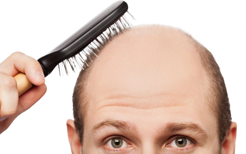 Rụng tóc do gen gây nên hói đầu