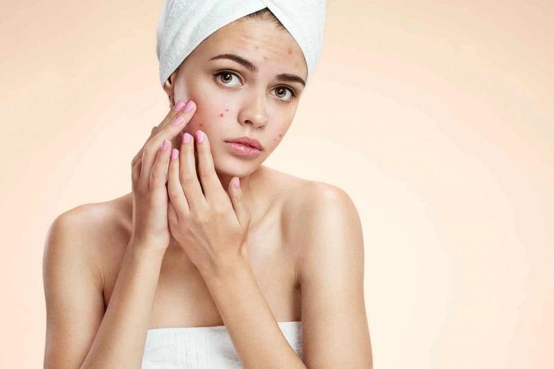 Bạn cần lưu ý gì trong điều trị sẹo lõm?2