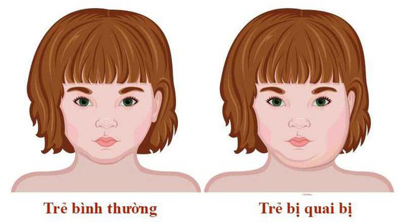 Bạn có biết bị quai bị bao lâu thì khỏi không? 1