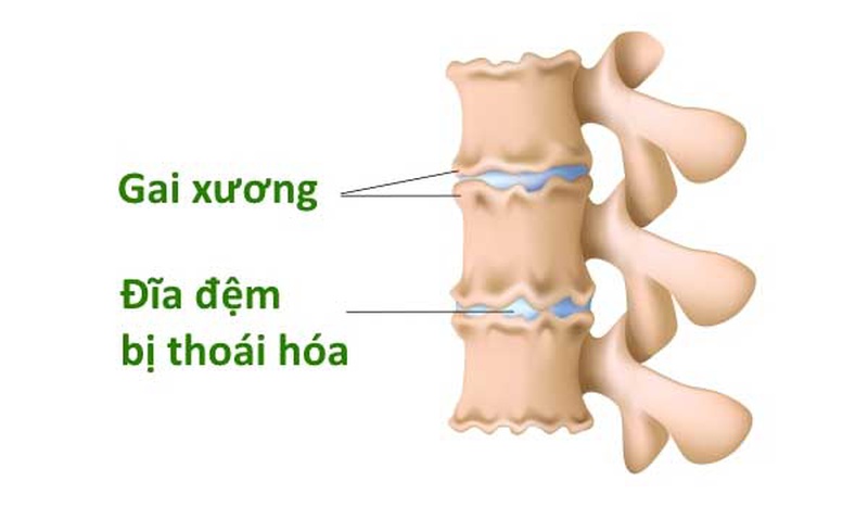 Bạn có biết gì về cơ chế hình thành các xương gai cột sống trong cơ thể 1