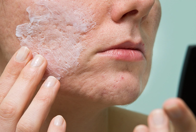 Sữa chua Hy Lạp hỗ trợ điều trị mụn