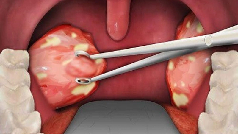 Bạn đã biết cách chữa viêm amidan hốc mủ 2