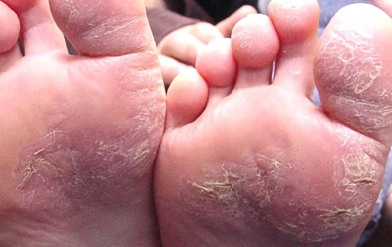 Cách trị đầu ngón chân khô nứt, bong tróc và rướm máu hiệu quả là vấn đề được nhiều người quan tâm