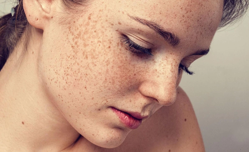 Bật mí 4 loại treatment da nám tốt nhất không nên bỏ qua 1