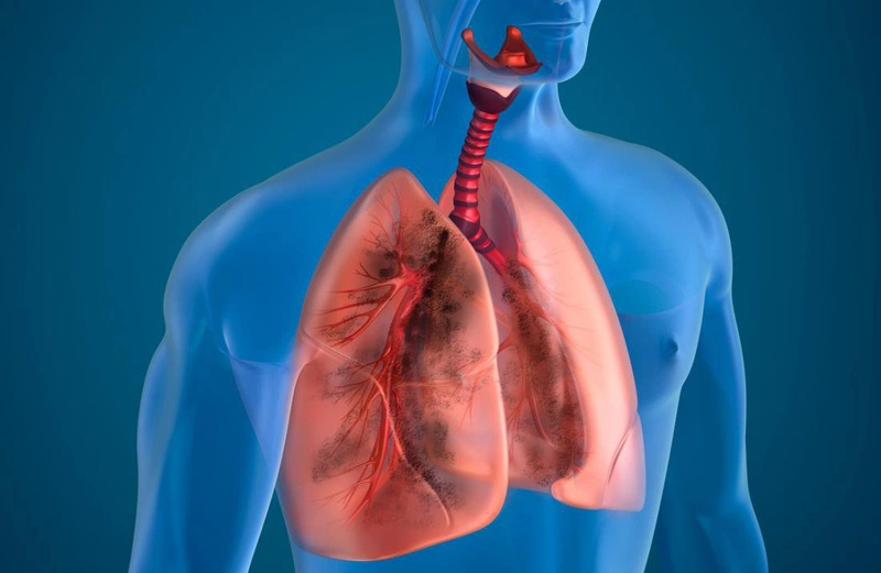 Bệnh nhân F0 có bệnh phổi tắc nghẽn mãn tính từ trước đang cách ly tại nhà  thì mức Sp02 cần liên hệ y tế là 92%