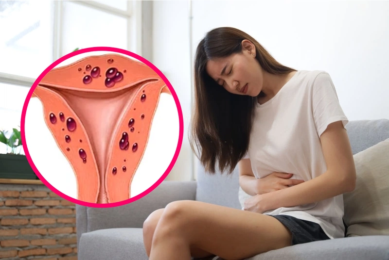 Các cơn đau lạc nội mạc tử cung mãn tính làm tăng nồng độ cortisol trong cơ thể