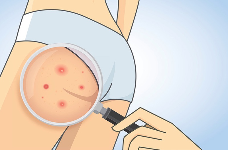 cách nặn mụn nhọt ở mông an toàn