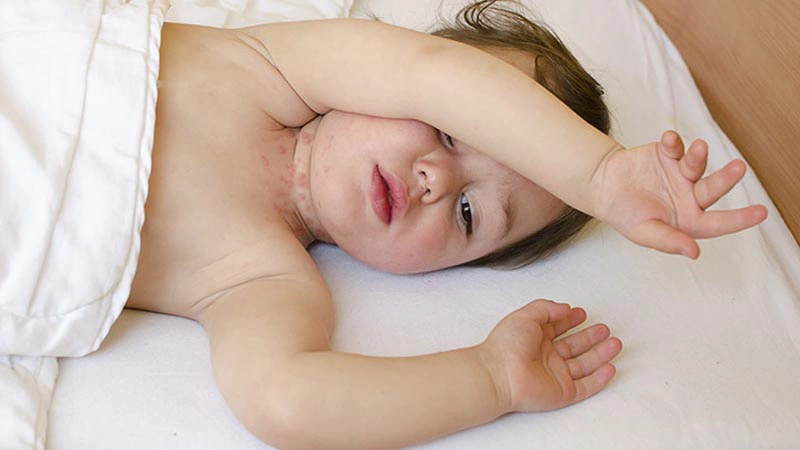 Hăm cổ kèm theo các mụn nước li ti
