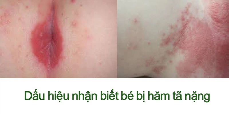 Khi bé bị hăm tã nặng nên đưa đến bác sĩ điều trị-1