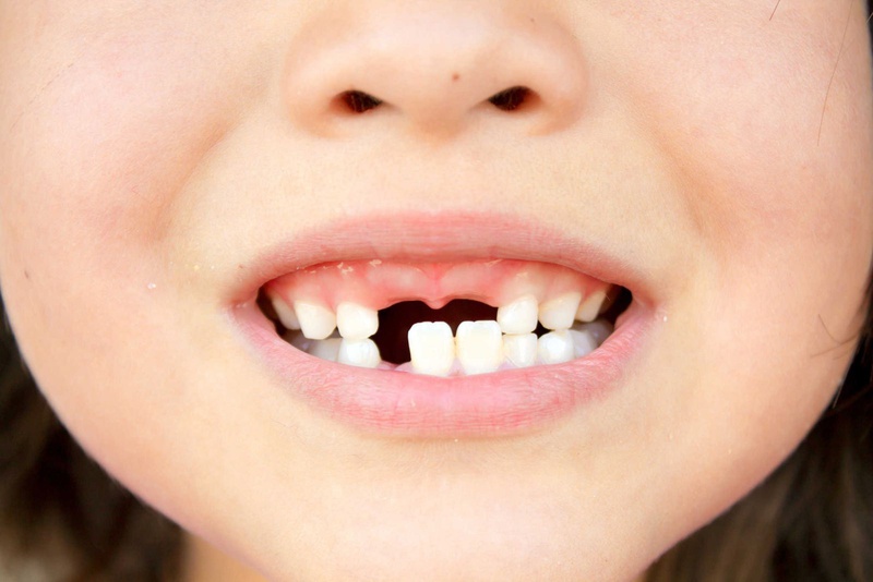 Nguyên nhận khiến trẻ bị sún răng - Nhà thuốc FPT Long Châu